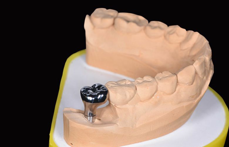 Proyecto de diseño de implantes